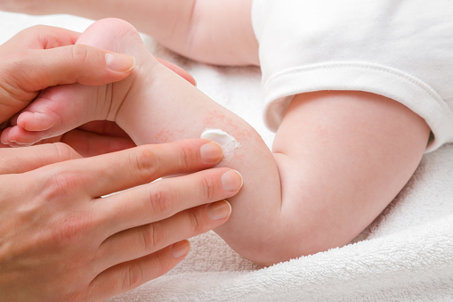 La dermatitis en los niños y en los bebés